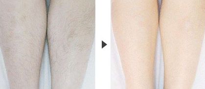 廣州疤痕醫(yī)院排名哪家好？了解廣州疤痕醫(yī)院的綜合實(shí)力與口碑