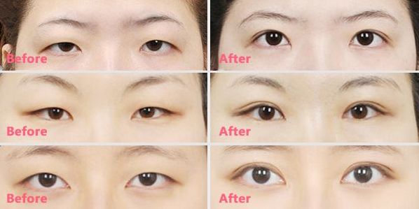 王曉晨的整容傳聞揭秘：真相到底如何？