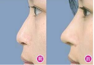 廣州整鼻最好醫(yī)院哪家好？2023年最新排名發(fā)布！