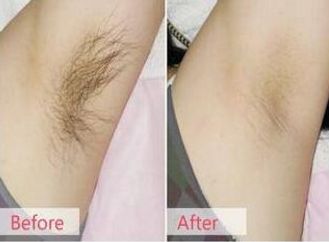 菏澤哪家醫(yī)院做雙眼皮效果好？