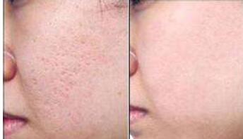 玻尿酸有哪些不同品牌？除皺后是否會留下疤痕？