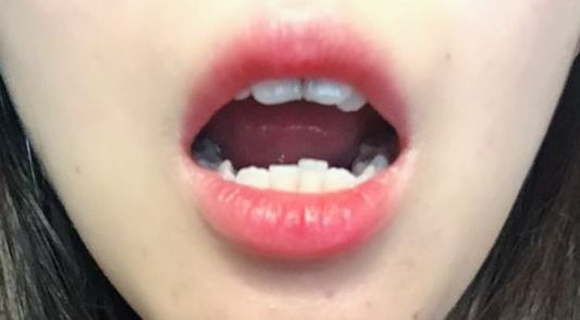 真相揭曉！angelbaby終于承認(rèn)整容了，來(lái)看看她的改變之路