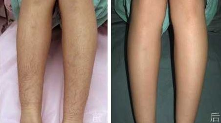 濰坊割雙眼皮前需要了解的6個(gè)最佳醫(yī)院，濰坊割雙眼皮醫(yī)院哪家好？