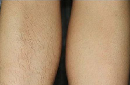 上海哪家醫(yī)院激光去痣好？解析上海頂級(jí)激光去痣醫(yī)院及技術(shù)