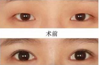 東莞哪家大腿抽脂醫(yī)院好？2023年排名前五強(qiáng)