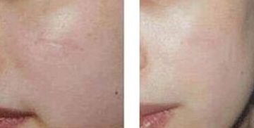 哪家合肥醫(yī)院專業(yè)安全割雙眼皮好？