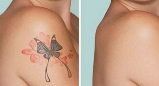 沈陽雙眼皮手術推薦，哪家醫(yī)院做的好？