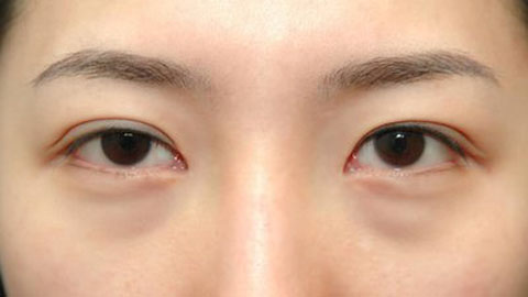 害怕韓式定點雙眼皮副作用？如何輕松預防？