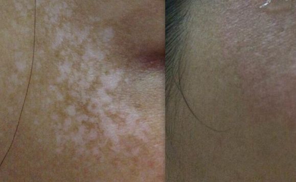 蘇州青春痘治療首選哪家醫(yī)院？找個專業(yè)靠譜的醫(yī)院解決青春痘問題