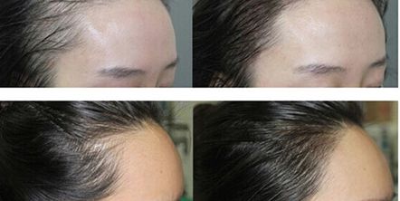 東莞做光子嫩膚哪家醫(yī)院專業(yè)靠譜？