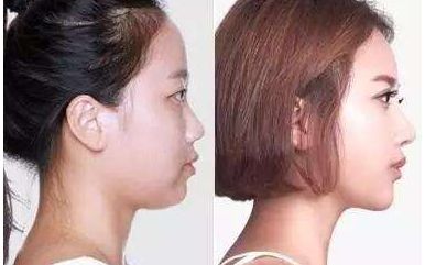 太原哪家醫(yī)院治療雀斑效果好？