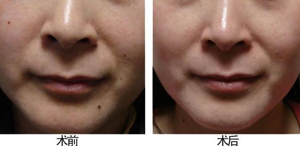 廣州做咬肌好的美容醫(yī)院有哪些？選擇哪家醫(yī)院效果最好？