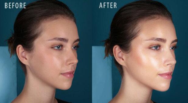 自體軟骨隆鼻適用范圍及注意事項(xiàng)有哪些