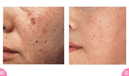 哈爾濱鼻整形醫(yī)院哪家好？選擇適合您的哈爾濱鼻整形醫(yī)院