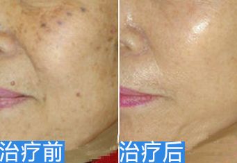 阜陽(yáng)祛疤痕哪家醫(yī)院好？如何選擇適合自己的祛疤痕醫(yī)院？