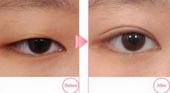 成都去雀斑哪家醫(yī)院好？挑選出適合你的四家頂級醫(yī)院！