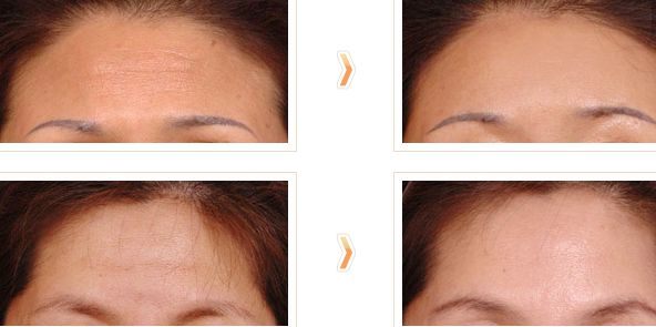 南寧醫(yī)院哪家專業(yè)治療黃褐斑效果好？