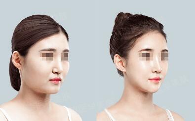 碘伏能不能治痘痘？碘伏介紹