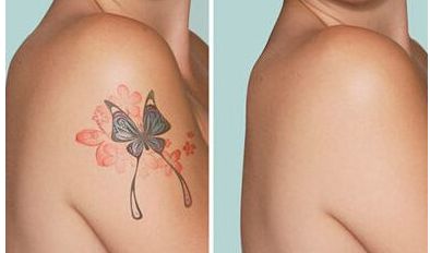 西安去胎記權(quán)威醫(yī)院排名及費(fèi)用如何？