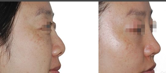 艾澤整容了嗎？探索明星整容的真相