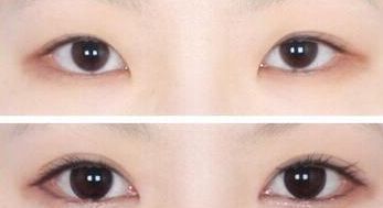 杭州哪家醫(yī)院做抽脂手術好，手術效果怎么樣，術前注意事項有哪些