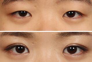 2023年濟南哪家醫(yī)院的PIP隆胸假體手術比較權威，排名前10強推薦！