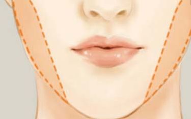 廣州哪家醫(yī)院做拉皮手術(shù)效果好？快來看看這里的選擇！