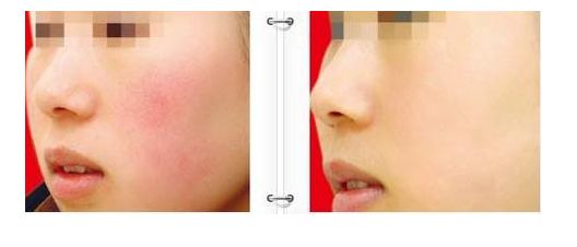 廣州哪家去掉疤痕醫(yī)院好？專家點評與患者評價揭示真相