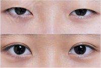 深圳哪些整形醫(yī)院是正規(guī)的韓式開眼角?？疲?023年評分排名前十強的尤其知名！