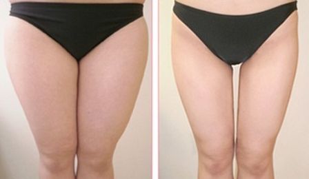 深圳脂肪填充臉哪家醫(yī)院好？專業(yè)醫(yī)院排行榜2023出爐了！