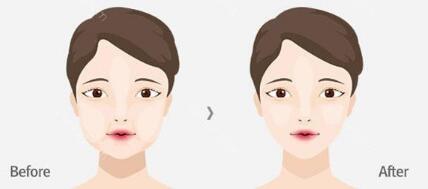 乳頭內(nèi)陷修復(fù)是否存在較大的潛在風(fēng)險(xiǎn)？如何有效避免不良反應(yīng)？