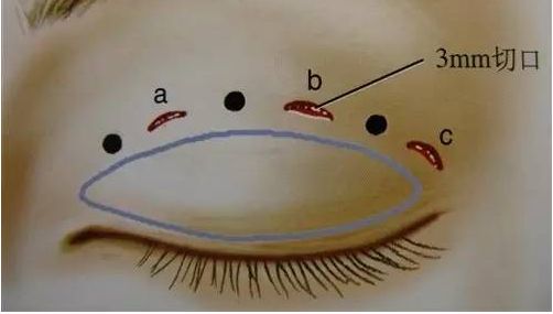 袁泉整容了嗎？曝光她疑似整容前后對比照片，網友熱議美容手術真相。
