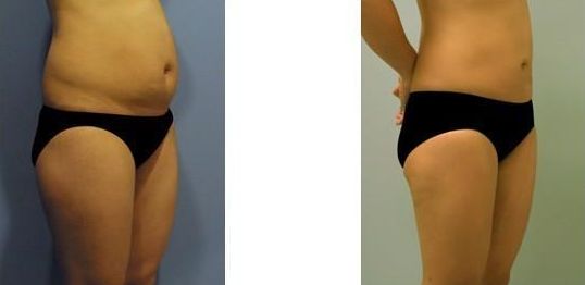 全國哪家醫(yī)院的脂肪填充效果最好？