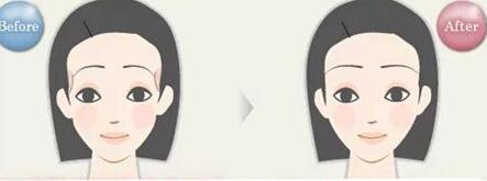 近視手術(shù)的利與弊，真的值得嗎？近視手術(shù)后需要注意哪些事項(xiàng)？