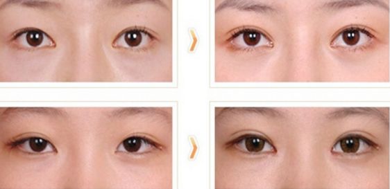 達(dá)州去眼袋的醫(yī)院哪家專業(yè)靠譜？