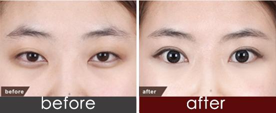 長沙哪家醫(yī)院的飛秒激光去黑毛痣技術(shù)出眾？2023年長沙前十家飛秒激光去黑毛痣醫(yī)院專家推薦！