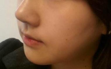 還在使用骨粉隆鼻？它的后遺癥究竟有哪些？！