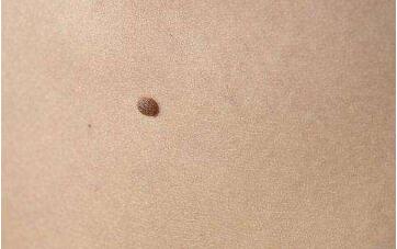 什么是最有效的墊鼻梁方法？如何選擇合適墊鼻材料？