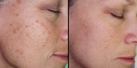 湖南去疤痕哪家醫(yī)院好？專家推薦的湖南治療疤痕首選！