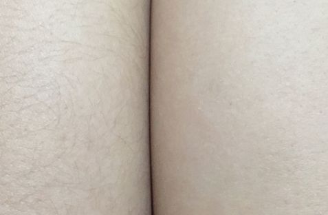 杭州治療痘坑的醫(yī)院哪家好？選擇靠譜專業(yè)的醫(yī)院，告別痘坑煩惱