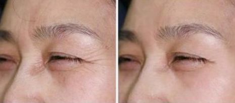 長春祛痘印痘疤哪家醫(yī)院好？探尋長春市最受用戶歡迎的祛痘佳所！