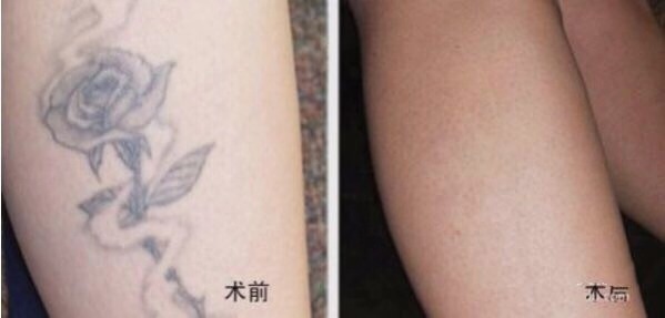 烤瓷牙的價(jià)格真的這么高嗎？烤瓷牙需要多長(zhǎng)時(shí)間恢復(fù)？