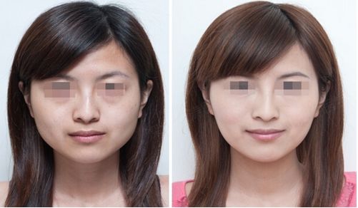 烏魯木齊哪家醫(yī)院隆鼻效果好？