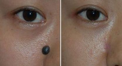 任丘激光去疤痕哪家醫(yī)院好？權(quán)威評(píng)測(cè)帶你尋找最適合的醫(yī)院！