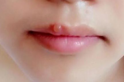 安慶有哪些專業(yè)的祛痘醫(yī)院值得推薦？