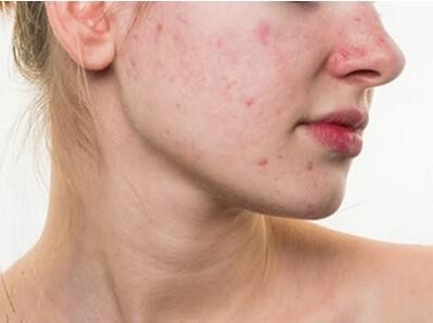 奧利司他膠囊減肥果安全有效嗎？有副作用嗎？