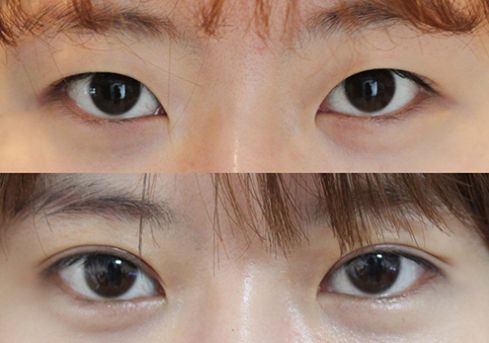 2023南京自體脂肪隆胸手術醫(yī)院排名TOP10，效果一覽無余！