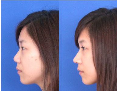 北京玻尿酸隆鼻哪家好？2023年口碑最佳醫(yī)院排行榜出爐！