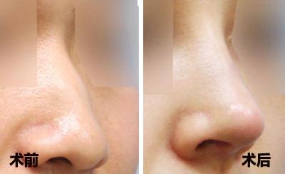 性價比！南寧哪些醫(yī)院值得選擇進(jìn)行雙眼皮整形術(shù)？2023年排行榜發(fā)布！南寧整形醫(yī)院前十可信賴！