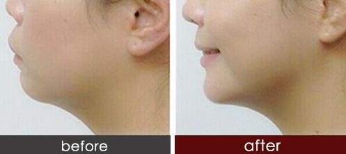 錦州哪家醫(yī)院做激光祛斑好？解密錦州專業(yè)的激光祛斑技術(shù)與經(jīng)驗(yàn)！